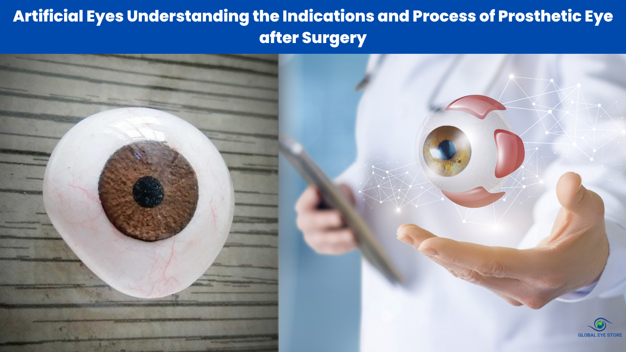 Artificial Eyes Understanding the Indications and Process of Prosthetic Eye after Surgery
